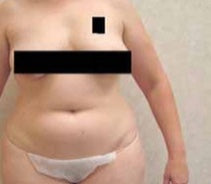 INSTAI LASER  - Derma advanced Android OS smart system